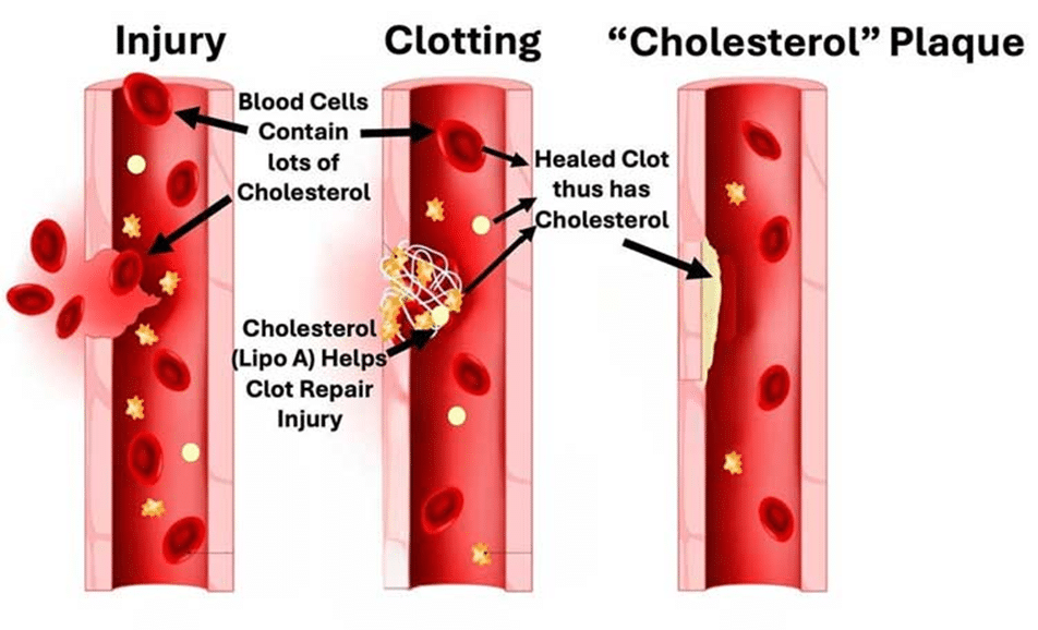 Expose News: Shocking truth! Statins don't cut heart disease risk and have nasty side effects. Is your cholesterol plaque a ticking time bomb? - The Expose Expose News: Shocking truth! Statins don't cut heart disease risk and have nasty side effects. Is your cholesterol plaque a ticking time bomb?